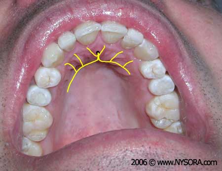 Description: http://www.nysora.com/files/2013/oral-maxillofacial-regional-anesthesia/15a.jpg
