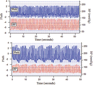 Pulse Oximetry