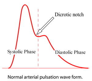 dicrotic notch