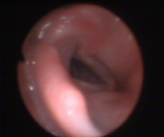 FIBEROPTIC INTUBATION