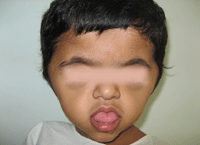 Apert Syndrome