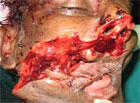 OPISTHOTONUS-AND-MYOCLONIC